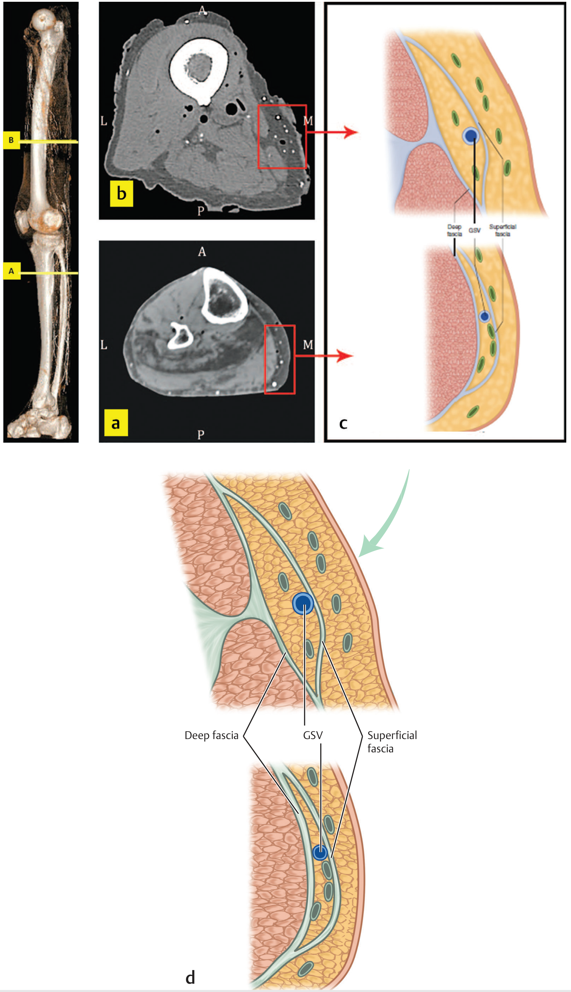 CT lymphography and diagram of superficial lymphatic collectors of the leg