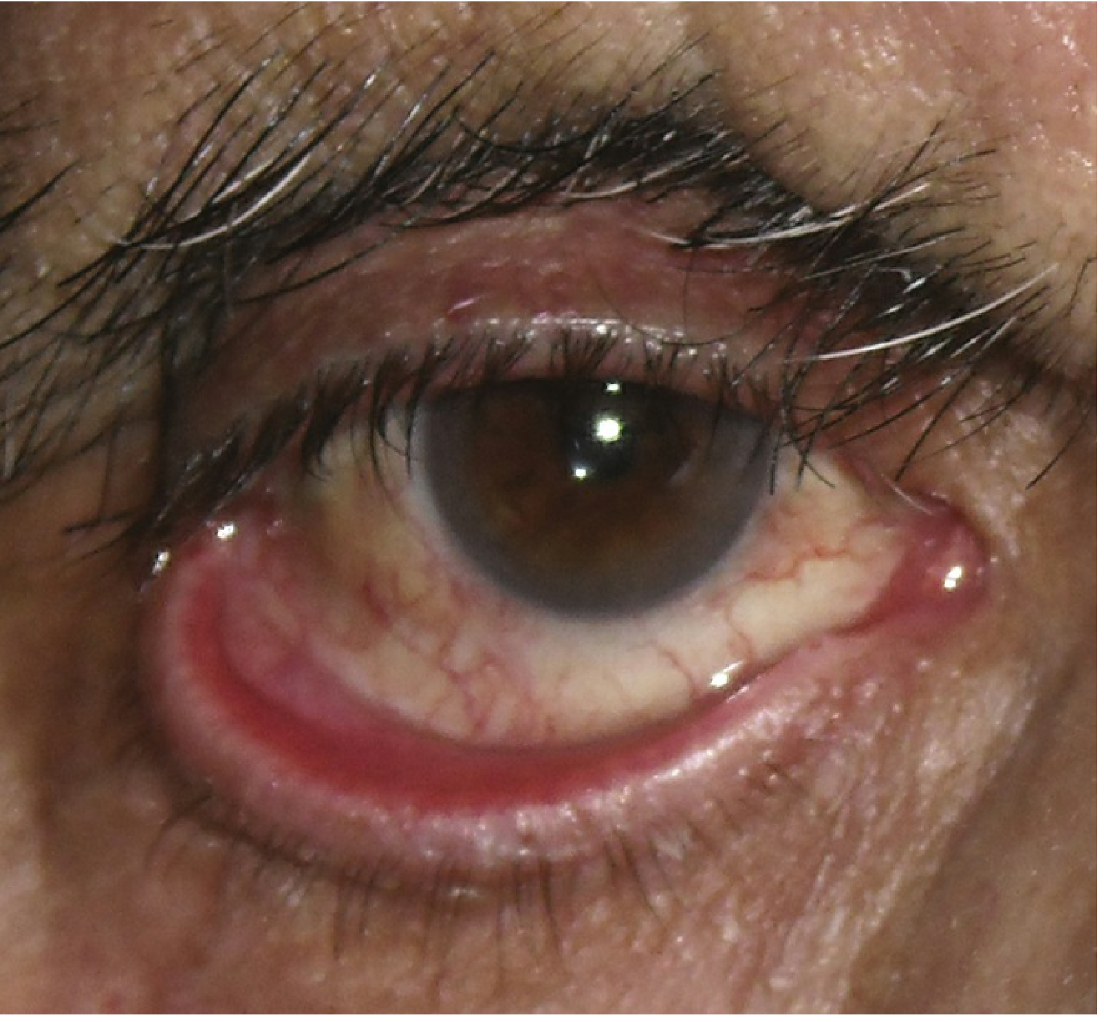 Ectropion - outward turning of the lower eyelid with exposed, inflamed conjunctiva