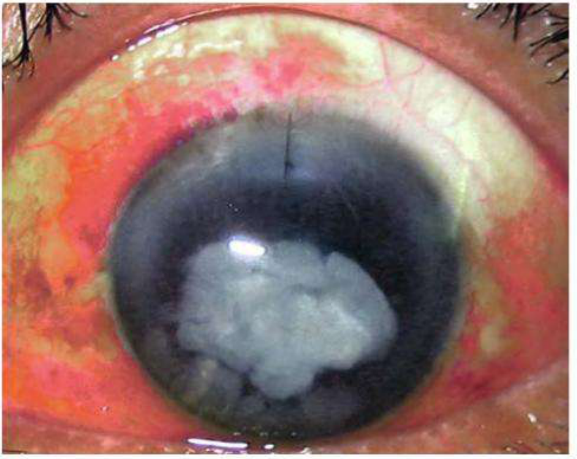 Endophthalmitis severe hypopyon and corneal involvement - Kanski
