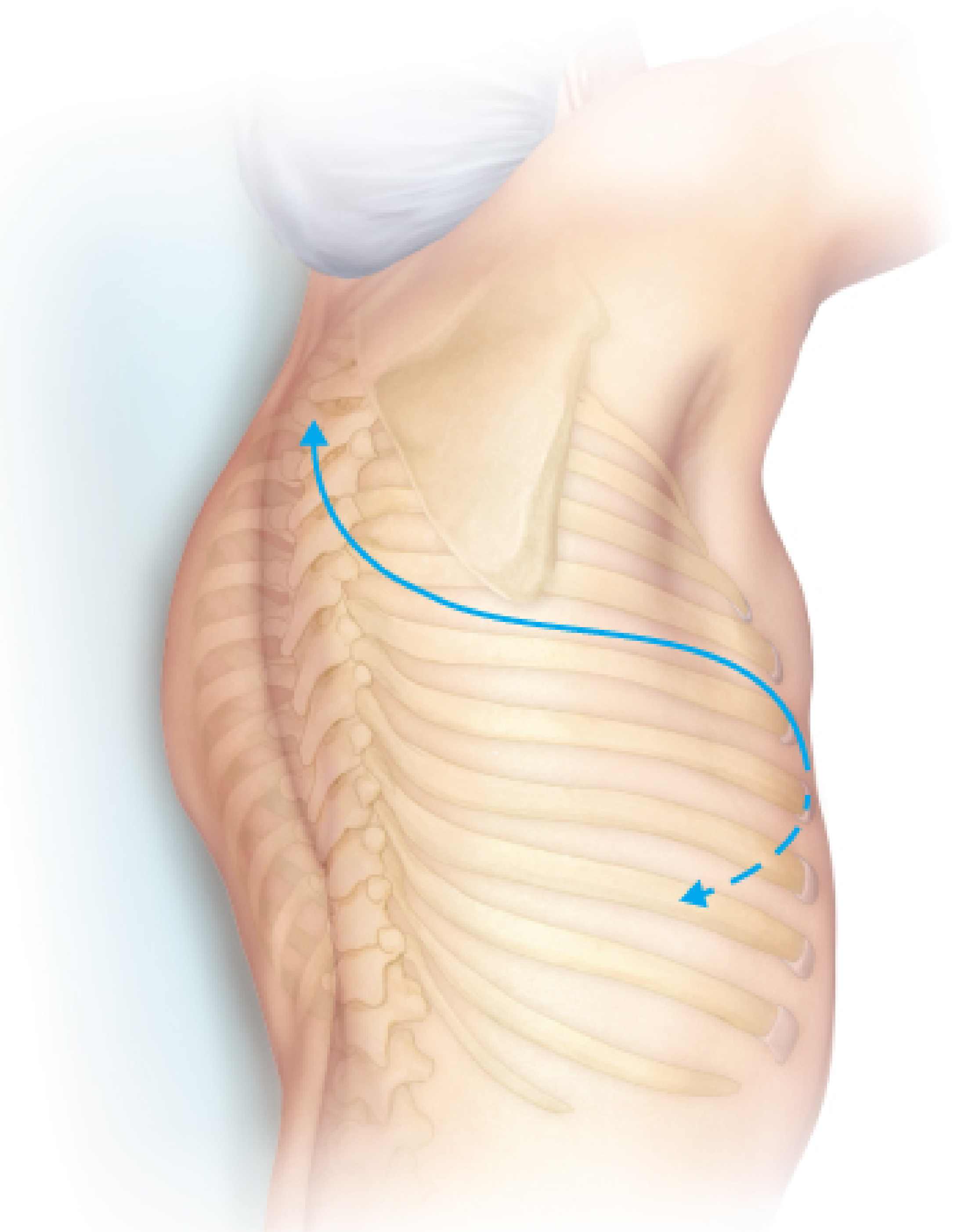 Standard posterolateral thoracotomy incision line showing the three anatomical points