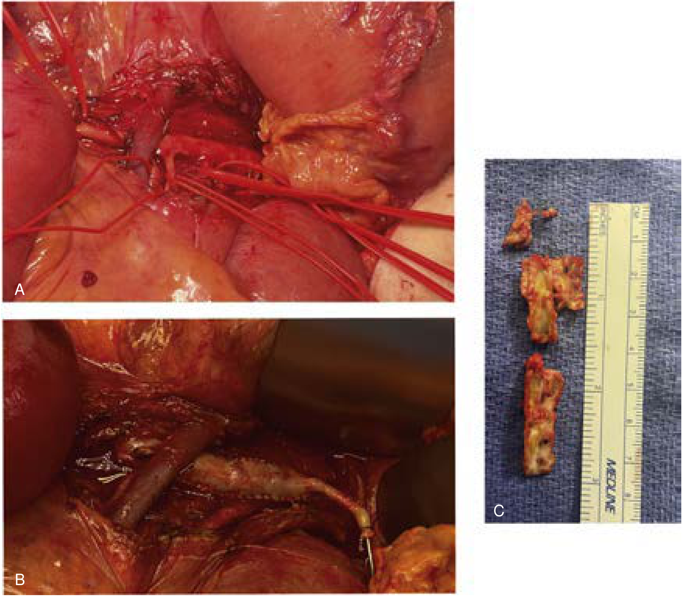 FIG. 11 — SMA endarterectomy