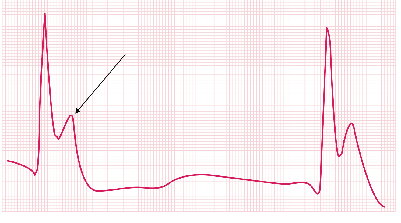 J (Osborne) wave on ECG in hypothermia