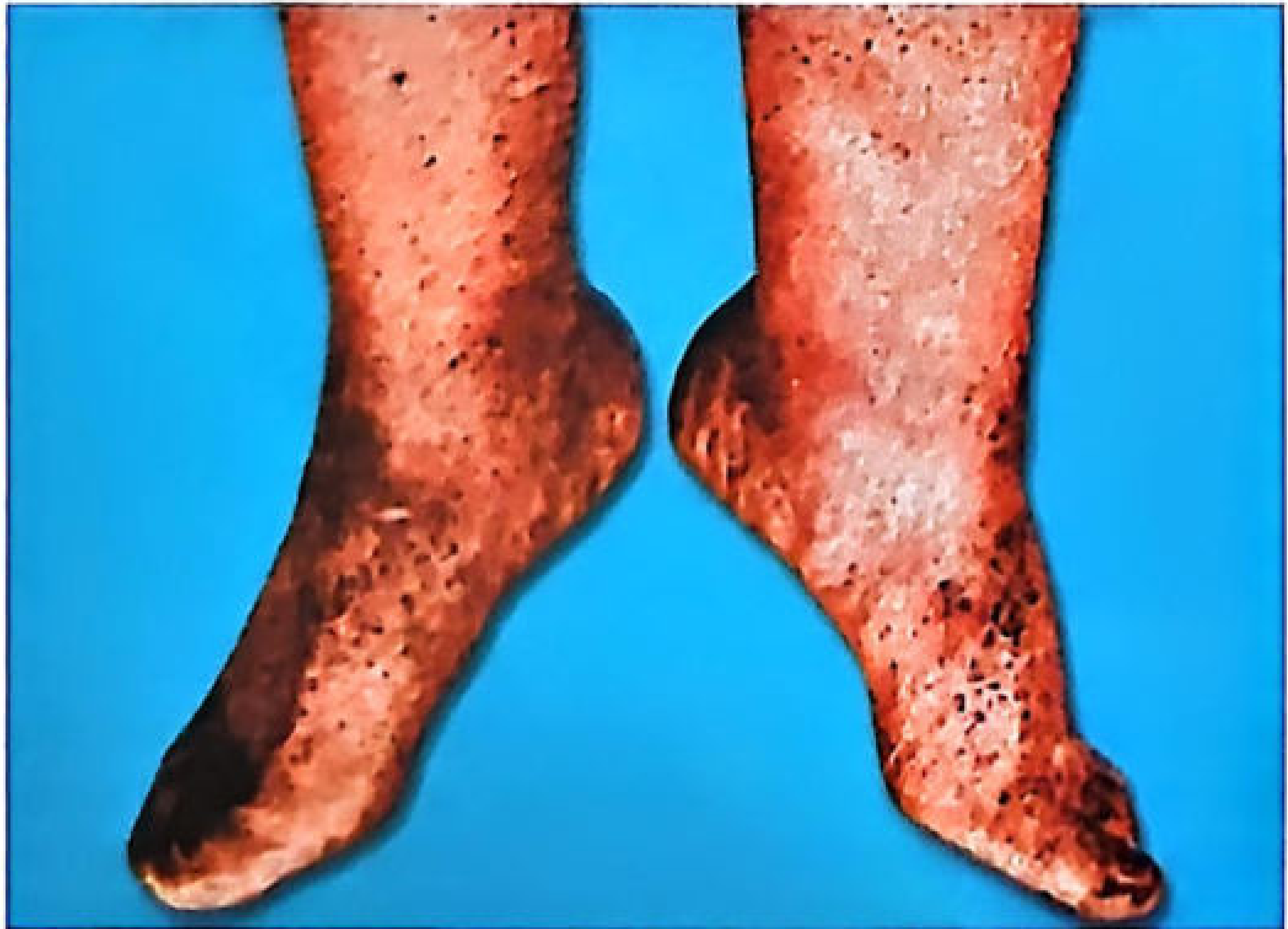 Tardieu spots on feet and legs in a case of hanging