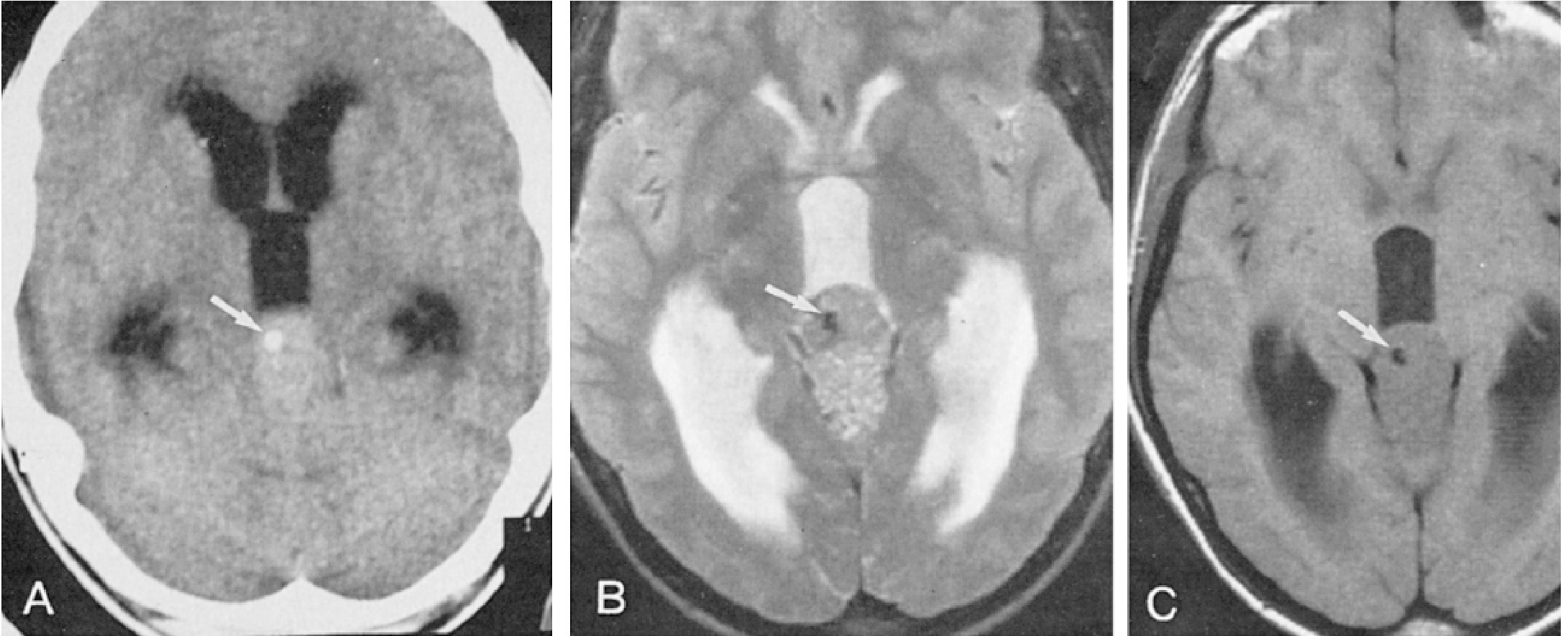 CT vs MRI comparison - same patient, showing pineal calcification (arrow)