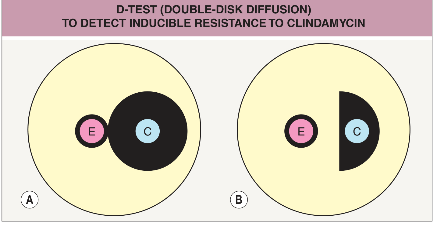 D-test diagram - A = D-test negative (circular zone around clindamycin), B = D-test positive (flattened D-shaped zone)