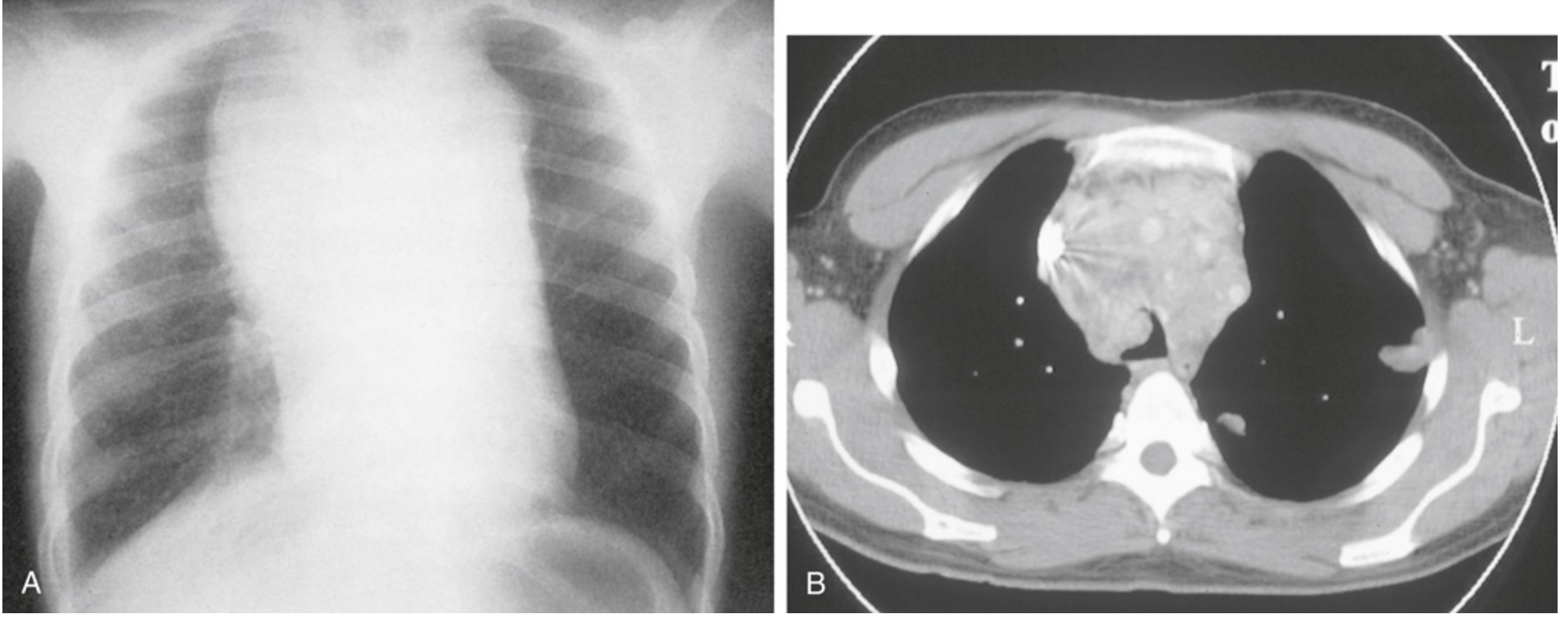 Mediastinal mass with tracheal compression - CXR and CT