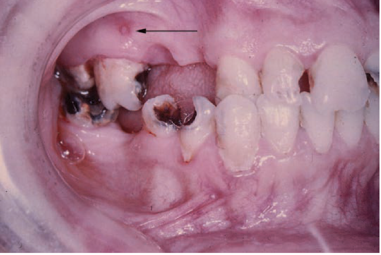 Parulis — gingival swelling with draining fistula superior to maxillary molar (arrow)