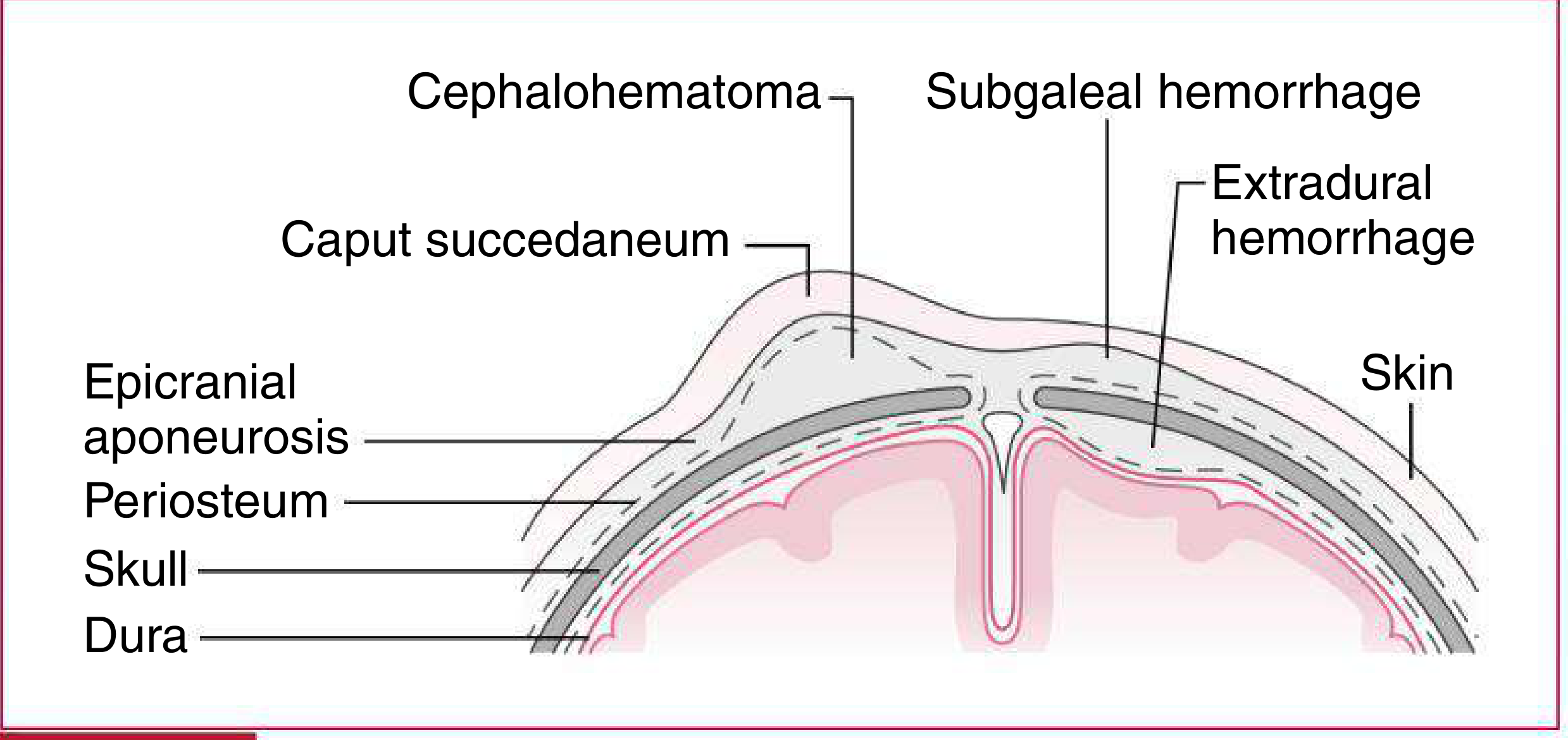 Types of extradural fluid collections seen in newborn infants