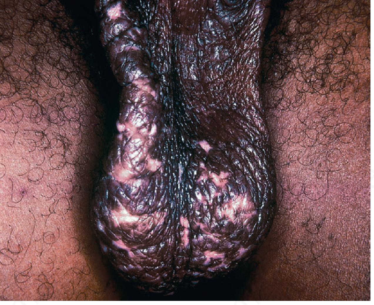 Pruritus Scroti - Lichen Simplex Chronicus