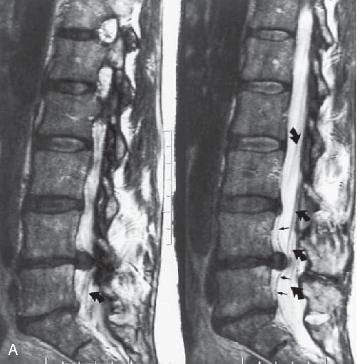 Lumbar MRI - L4-L5 disc herniation compressing cauda equina roots