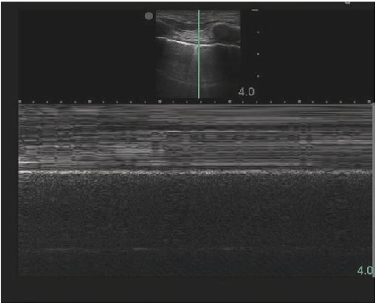 Normal M-mode "seashore sign": chest wall lines above, granular lung below