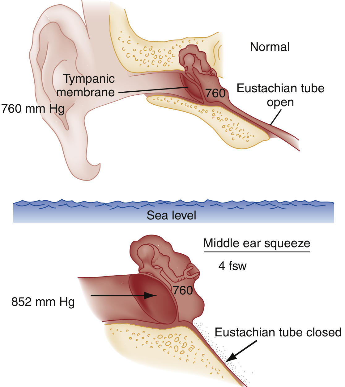 Middle ear barotrauma diagram showing tympanic membrane stretching when Eustachian tube is closed