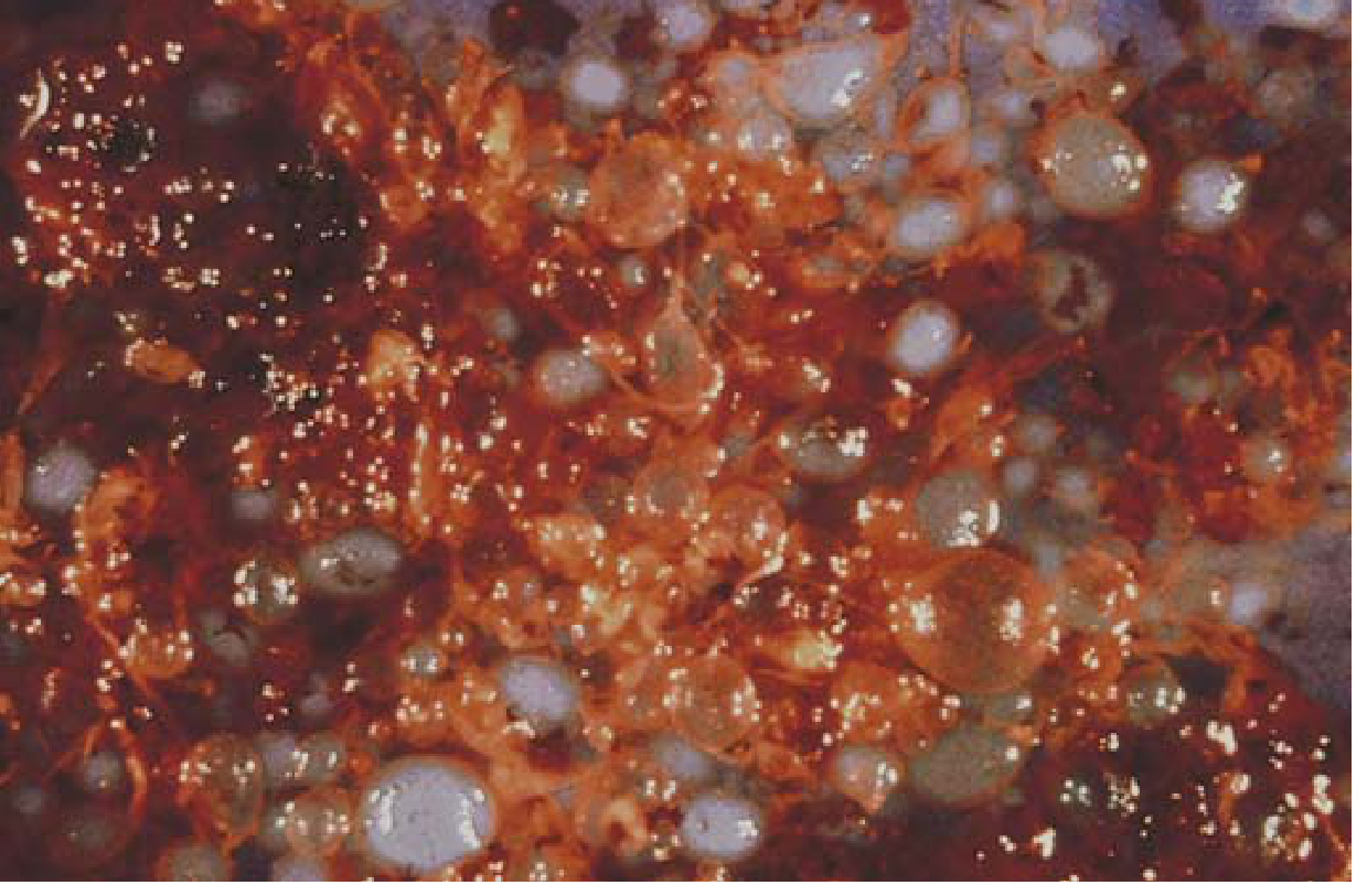 Complete hydatidiform mole - gross: numerous swollen (hydropic) villi