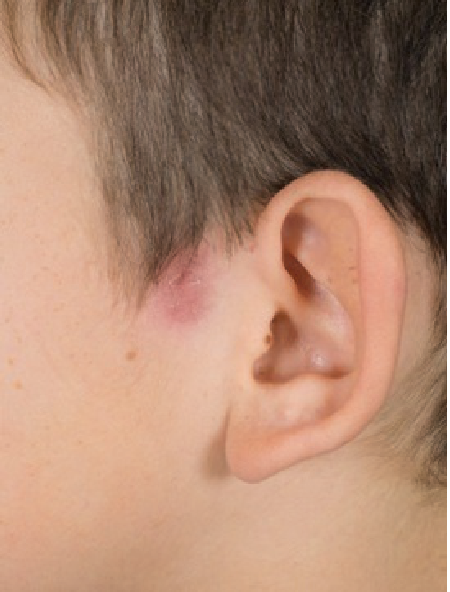 Inflamed left preauricular sinus