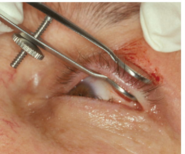Clinical photo: chalazion clamp stabilizing the eyelid during incision and drainage
