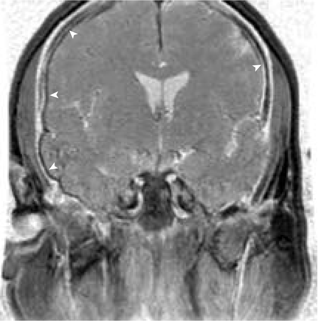 Contrast-enhanced MRI showing dural enhancement (arrowheads) caused by otogenic meningitis - Cummings Otolaryngology