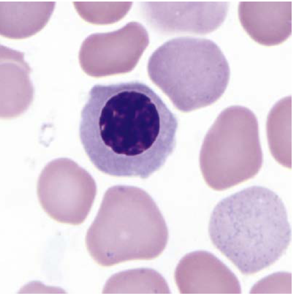 Polychromatophilic normoblast - cell with light blue cytoplasm and condensed nucleus surrounded by mature red blood cells