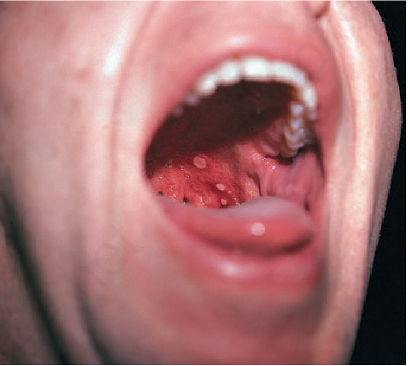 Herpangina — whitish vesicular ulcers on the erythematous posterior pharynx caused by coxsackievirus