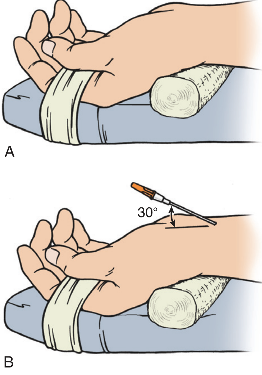 Radial artery cannulation - wrist position (A) and 30-degree needle insertion angle (B)
