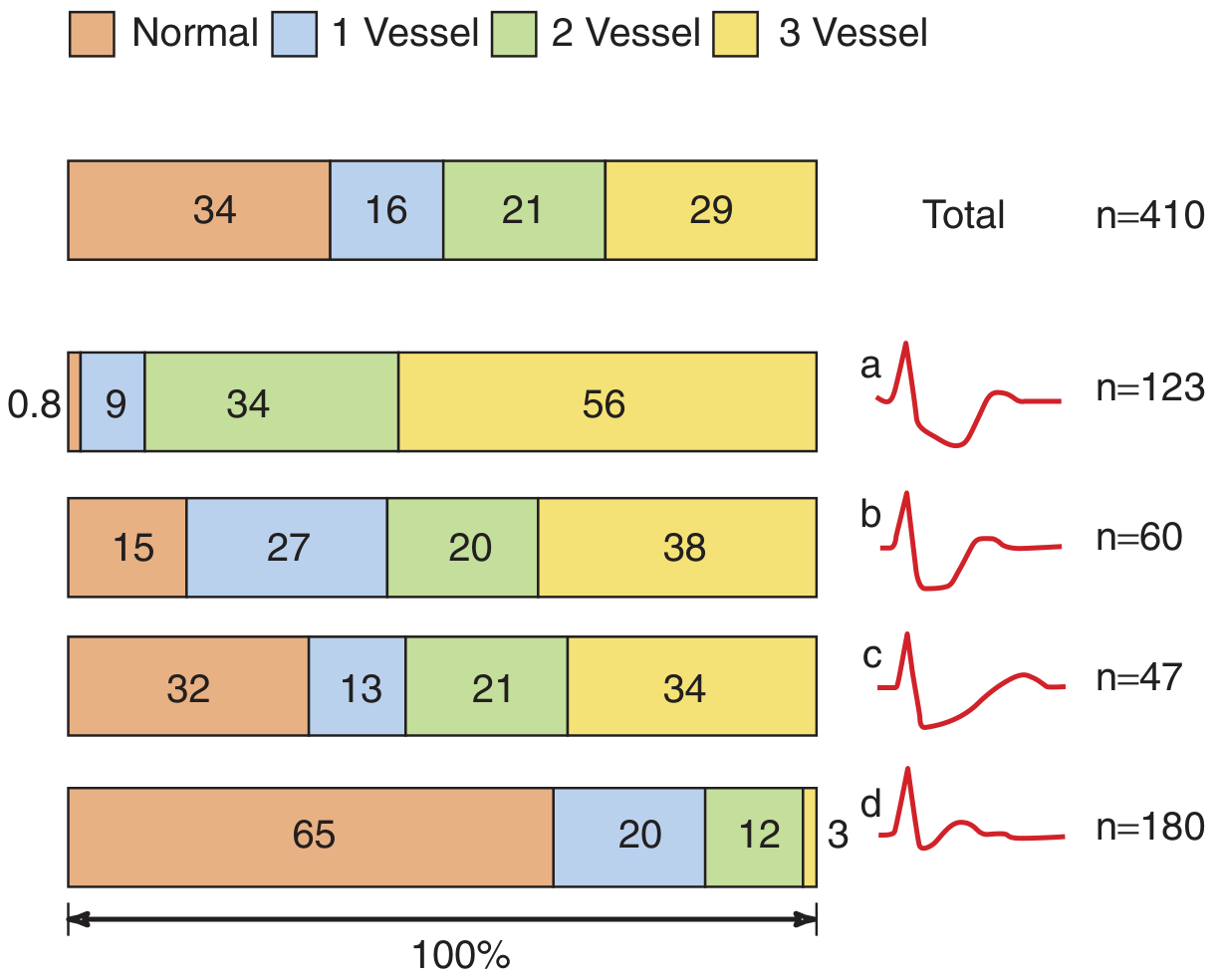 ST depression patterns a-d: downsloping, flat, slow upsloping, rapid upsloping and their relation to coronary artery disease