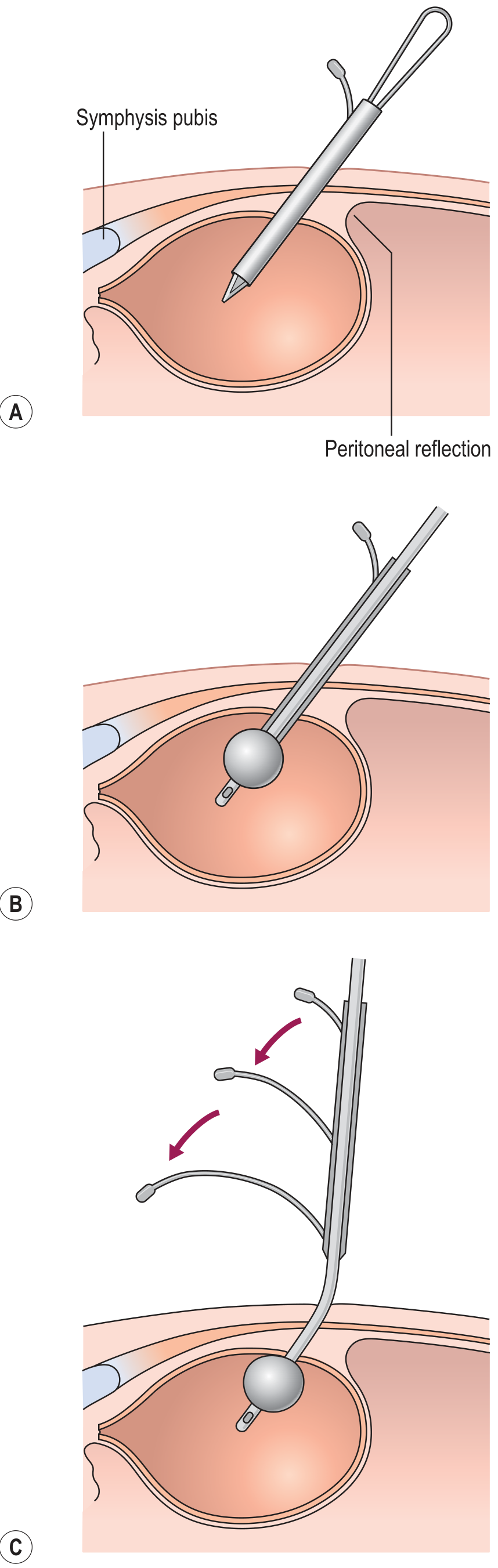 Suprapubic catheter insertion technique showing trocar through symphysis pubis, balloon inflation, and peel-away sheath removal