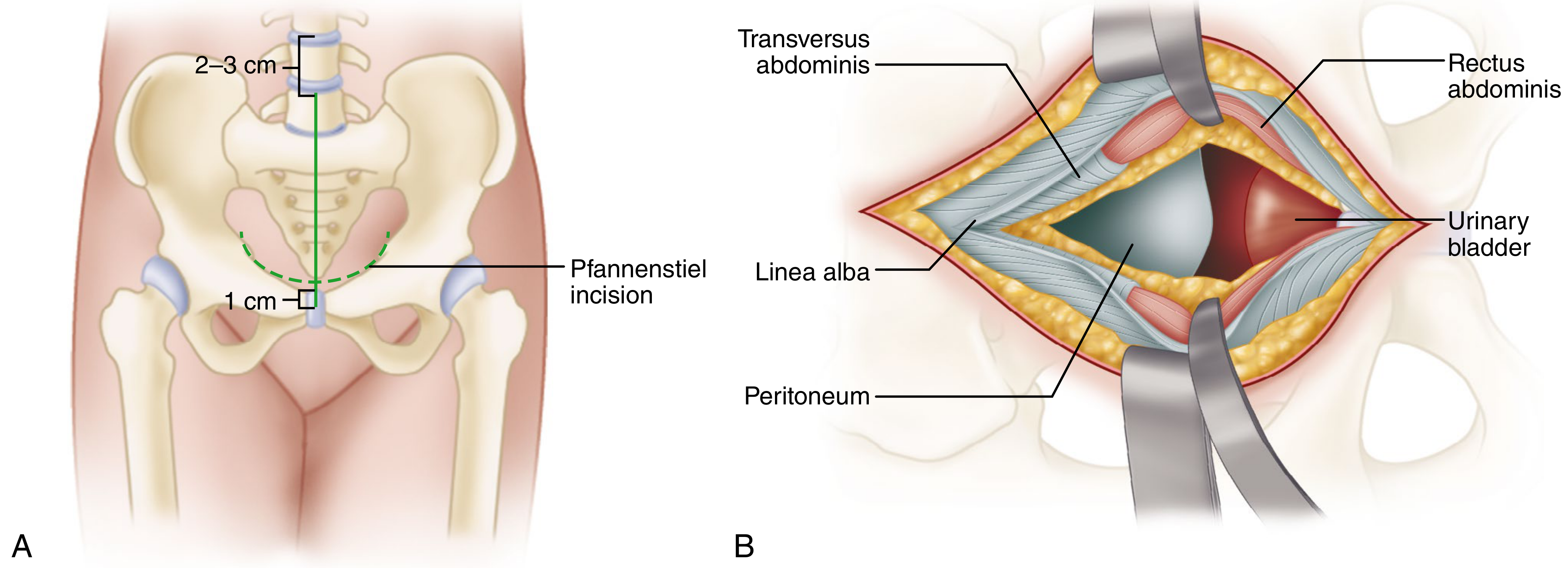 Incision - Pfannenstiel/midline with linea alba and bladder visible