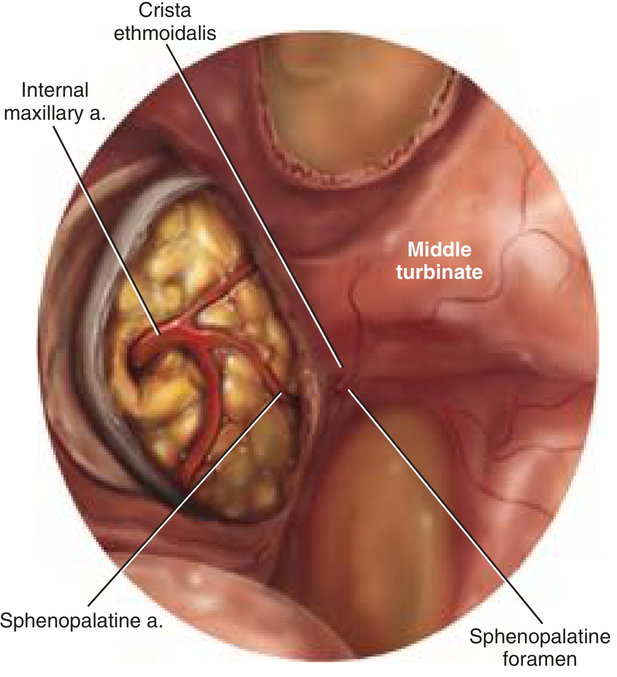 Endoscopic view showing internal maxillary artery, sphenopalatine artery, crista ethmoidalis, and sphenopalatine foramen - the key landmarks for entering the PPF