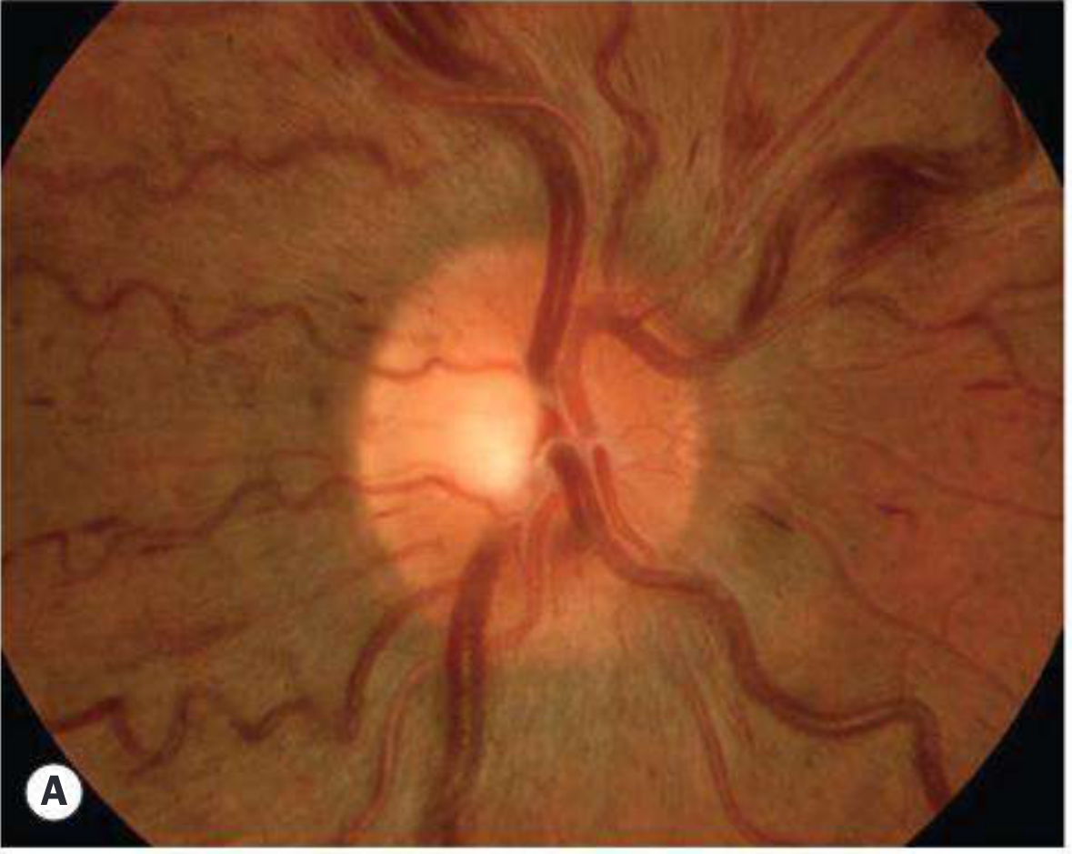Impending CRVO - retinal venous dilatation and tortuosity