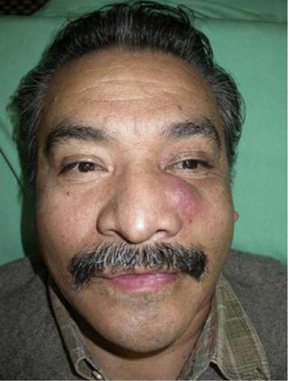 Left canine space infection showing characteristic infraorbital swelling and nasolabial fold obliteration
