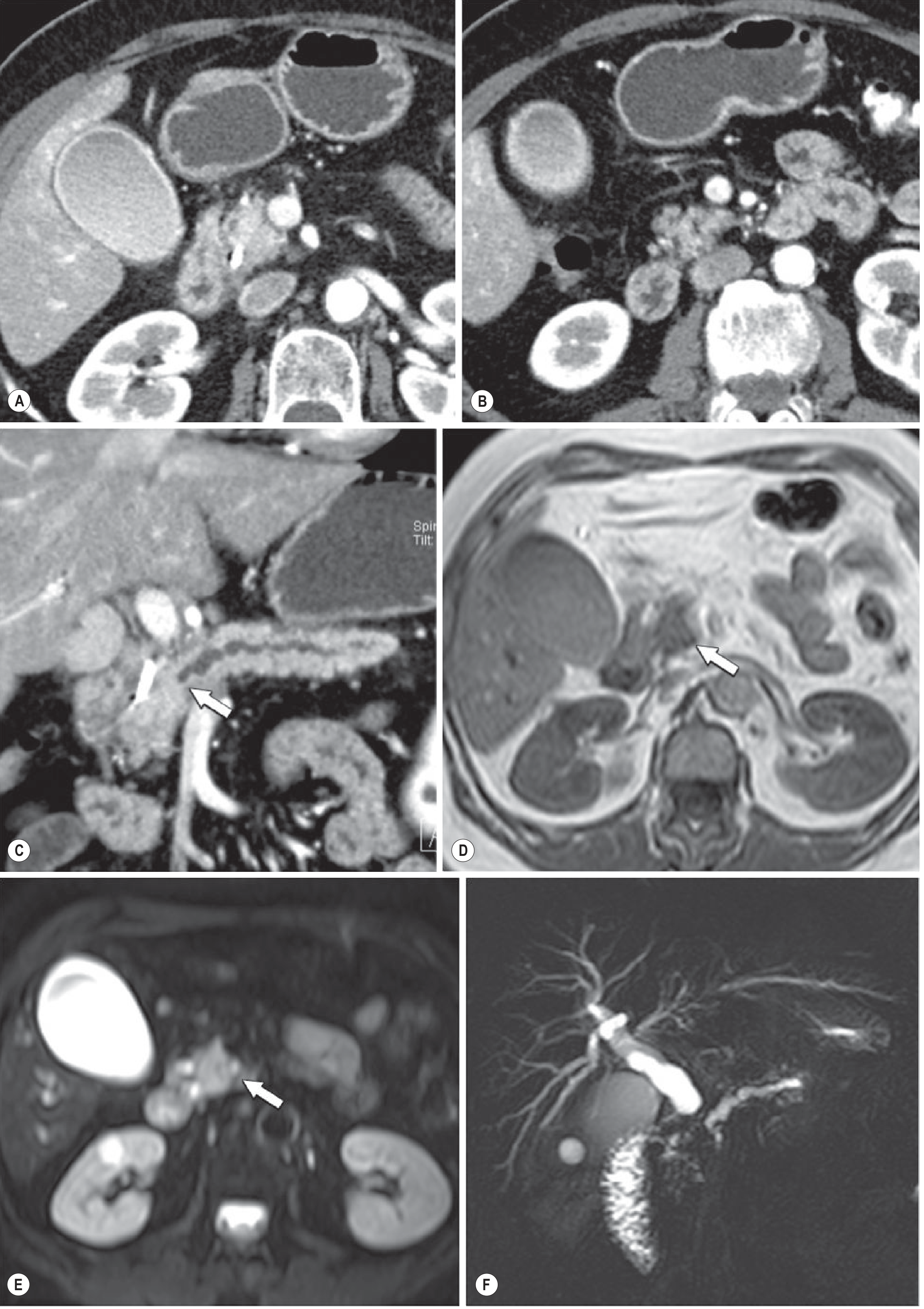 Isoattenuating Pancreatic Cancer - Indirect Signs on CT and MRCP