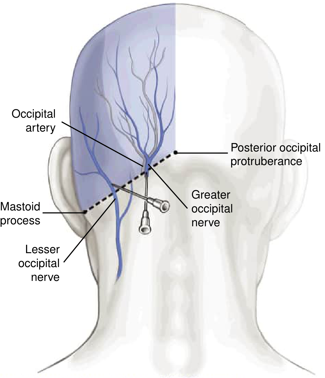 Greater and Lesser Occipital Nerve Block anatomical landmarks