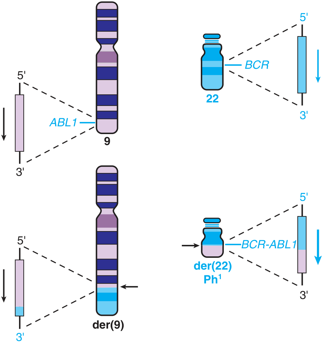 Philadelphia chromosome translocation - t(9;22): ABL1 from chromosome 9 fuses with BCR on chromosome 22 to form the BCR-ABL1 oncogene on the shortened der(22), the Philadelphia chromosome