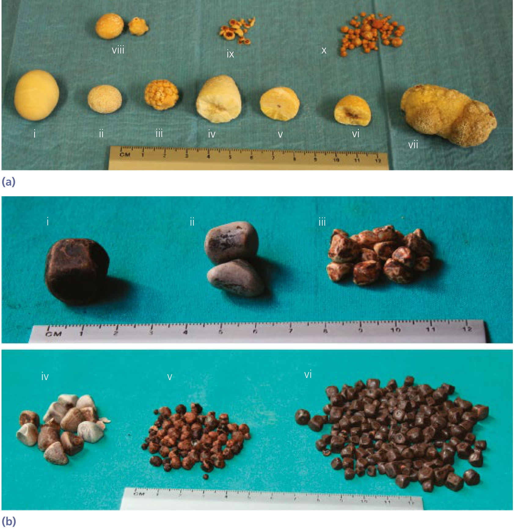 Yamada's Gastroenterology Figure 81.1 - (a) Pure cholesterol gallstones in various forms; (b) Mixed cholesterol stones - solitary (i), twin (ii), and multiple multifaceted (iii-vi)