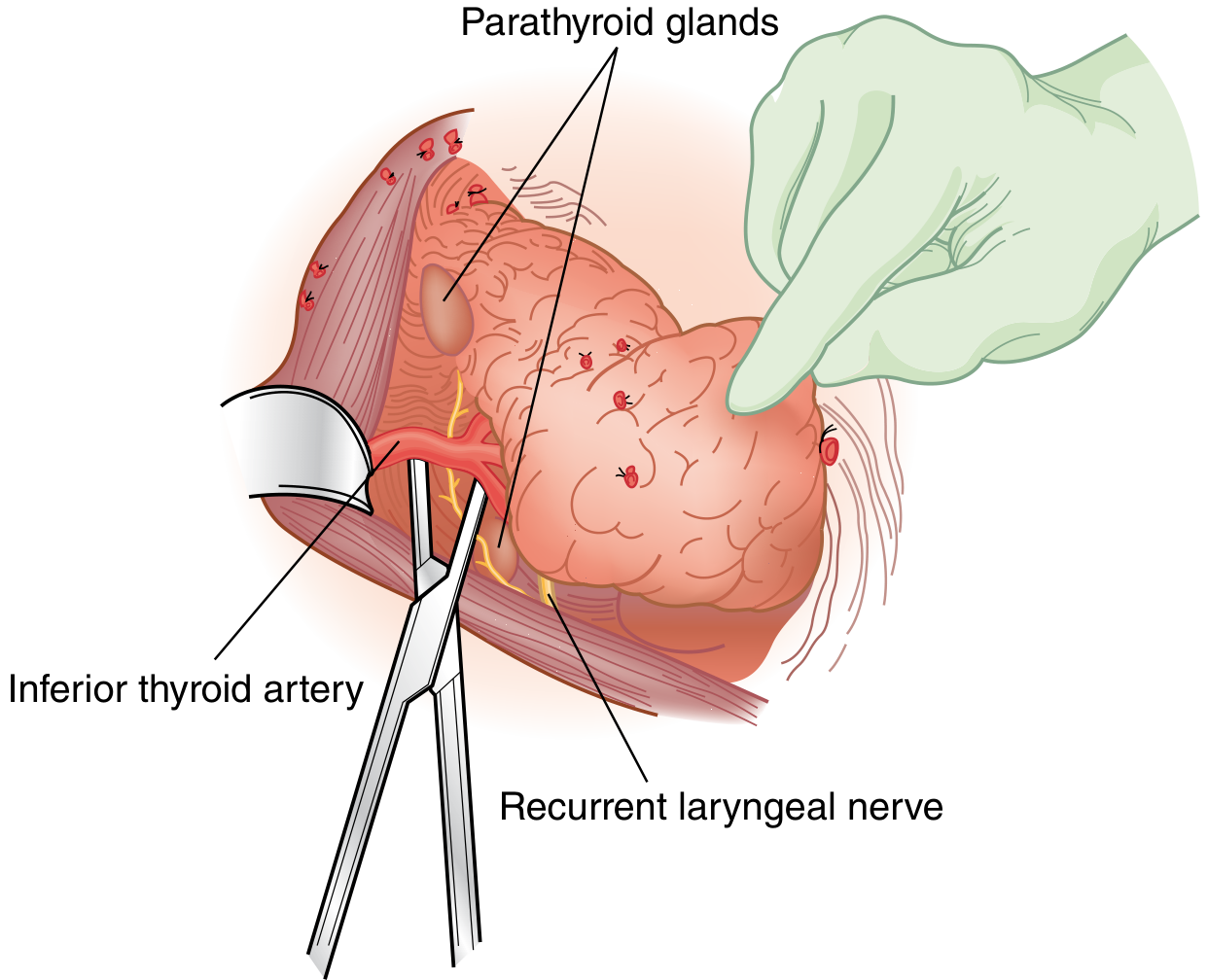 Surgical anatomy showing parathyroid glands, inferior thyroid artery, and recurrent laryngeal nerve during thyroid retraction