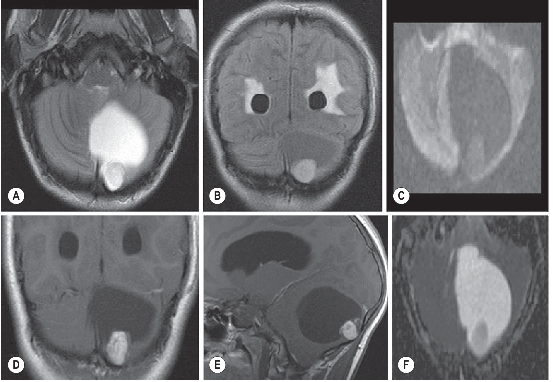 Cerebellar pilocytic astrocytoma - axial T2 (A), coronal FLAIR (B), coronal/sagittal T1+Gad (D,E) showing large cystic hemispheric tumor with solid enhancing nodule; DWI (C) and ADC (F) confirm NO restricted diffusion - contrast with medulloblastoma