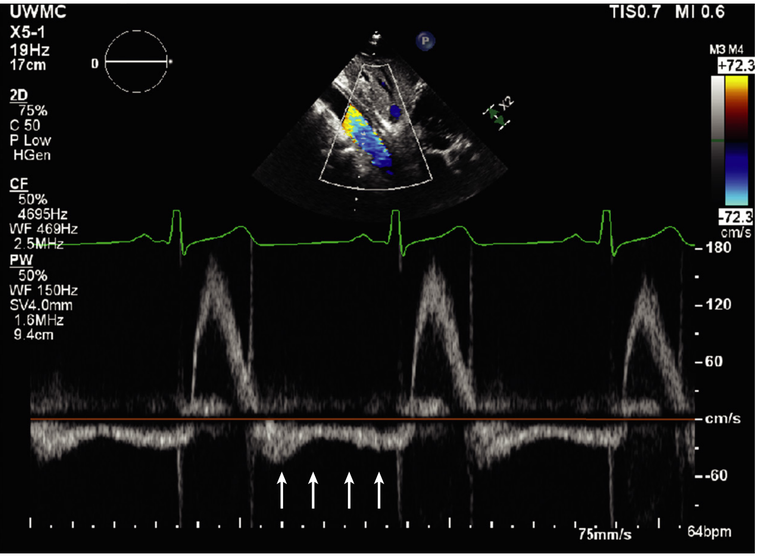 Holodiastolic aortic flow reversal in severe AR