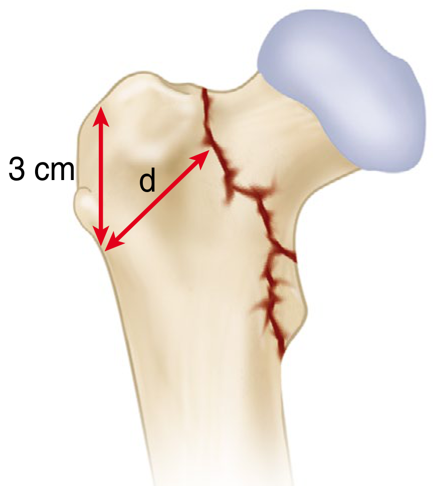 Lateral wall thickness diagram - 3 cm from innominate tubercle, measurement d at 135 degrees to fracture line