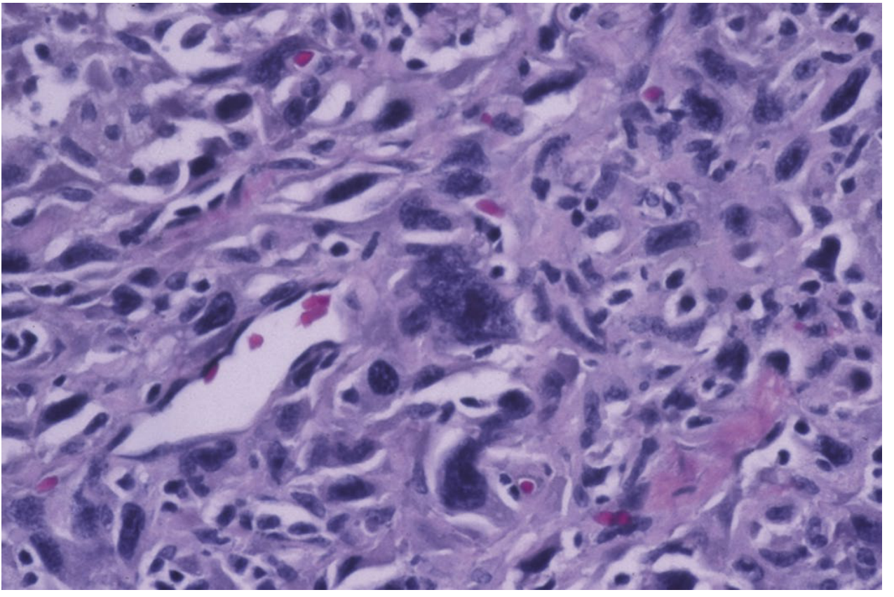 Anaplastic thyroid cancer - H&E staining showing marked nuclear pleomorphism, spindle cells, and multinucleated giant cells