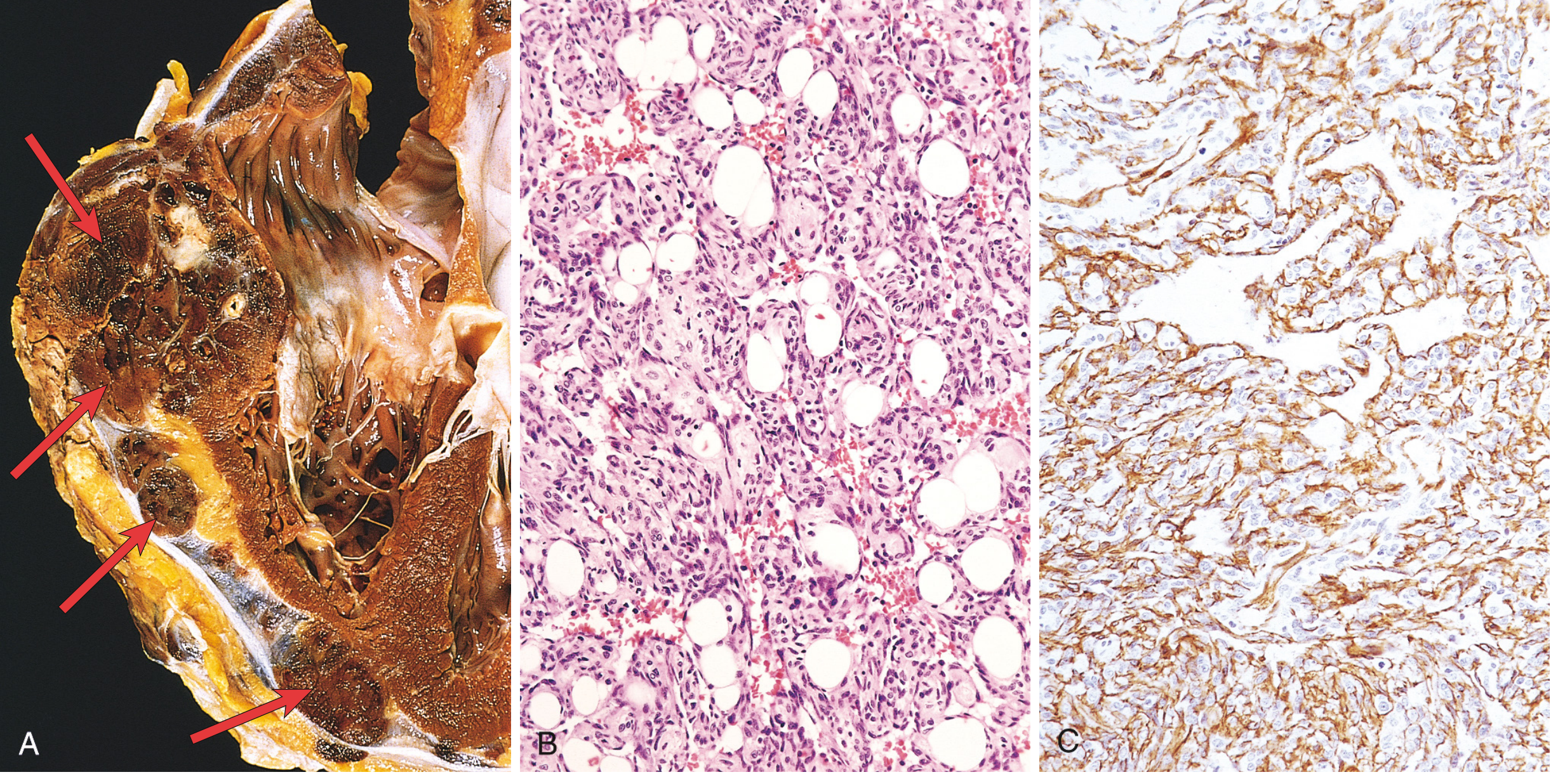 Angiosarcoma - Gross and Histology (Robbins). A: Angiosarcoma involving the right ventricle; B: Atypical cells lining vascular lumens (H&E); C: CD31 immunostaining confirming endothelial origin.
