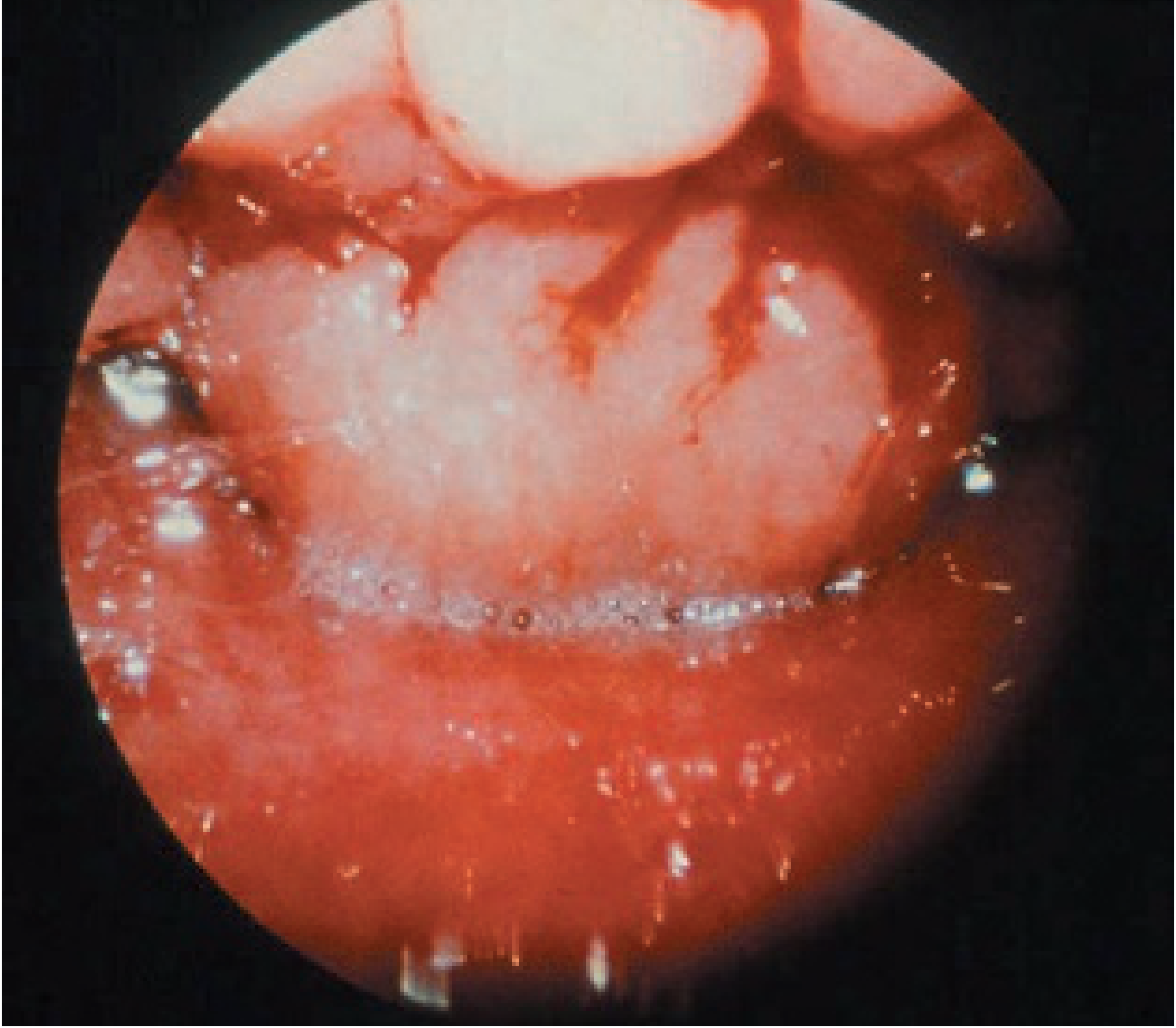 Endoscopic view of the adenoids