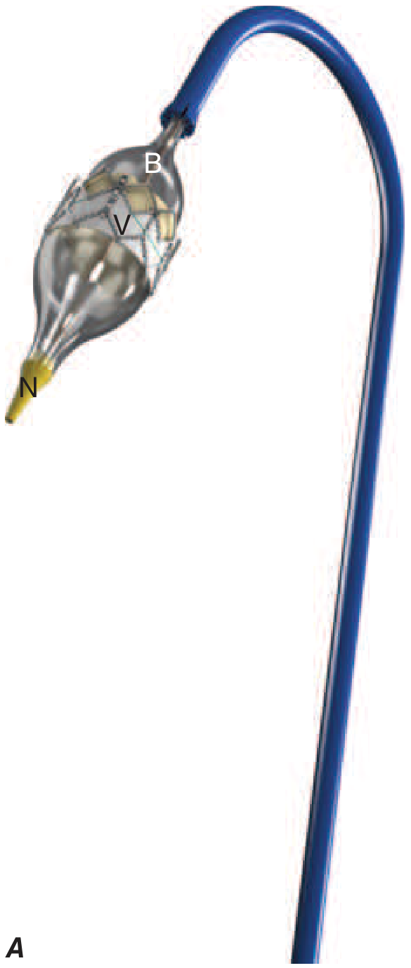 Balloon-expandable TAVI valve on delivery system - labelled B (balloon), V (valve), N (nose cone) with curved blue delivery catheter