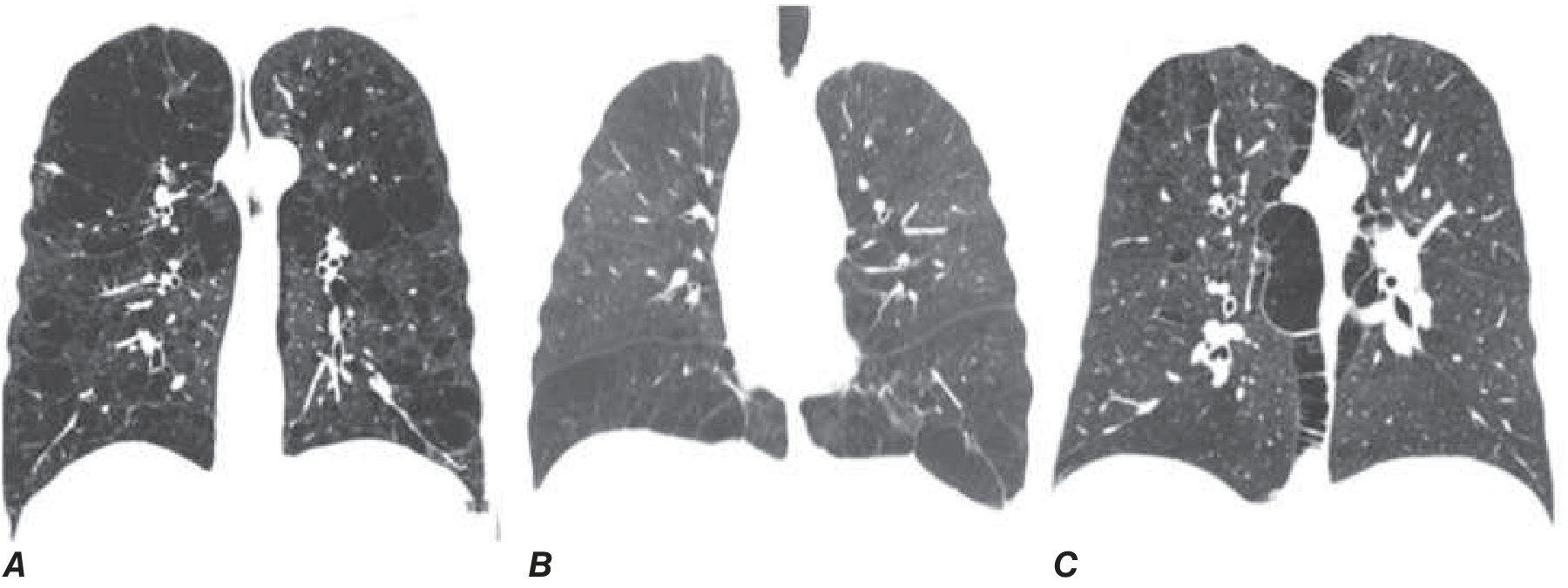 CT patterns of emphysema showing centrilobular (A), panlobular (B), and paraseptal/bullous (C) patterns