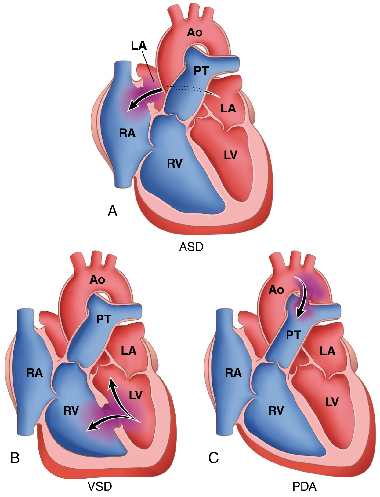 ASD hemodynamics — left-to-right shunt at atrial level