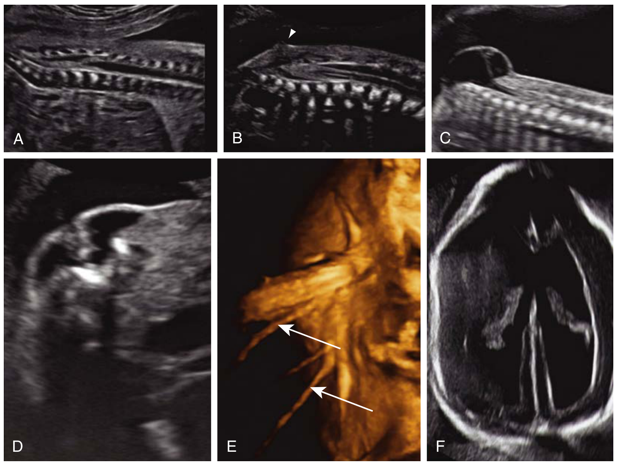 Second-trimester ultrasound showing myelomeningocele features including U-shaped splayed vertebrae, cystic protruding sac, and classic brain signs