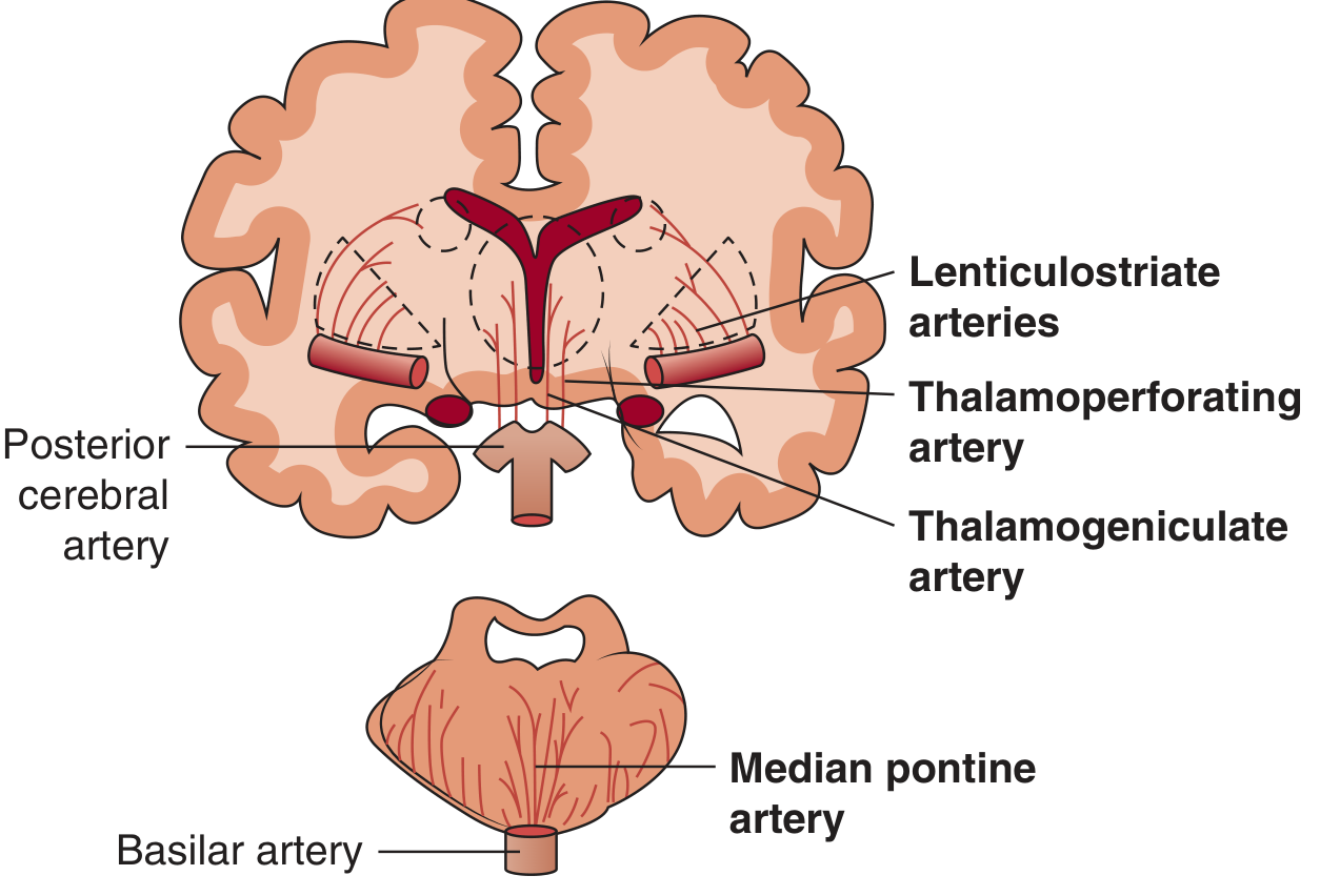 Deep penetrating arteries prone to lipohyalinosis - Fuster & Hurst's The Heart 15E