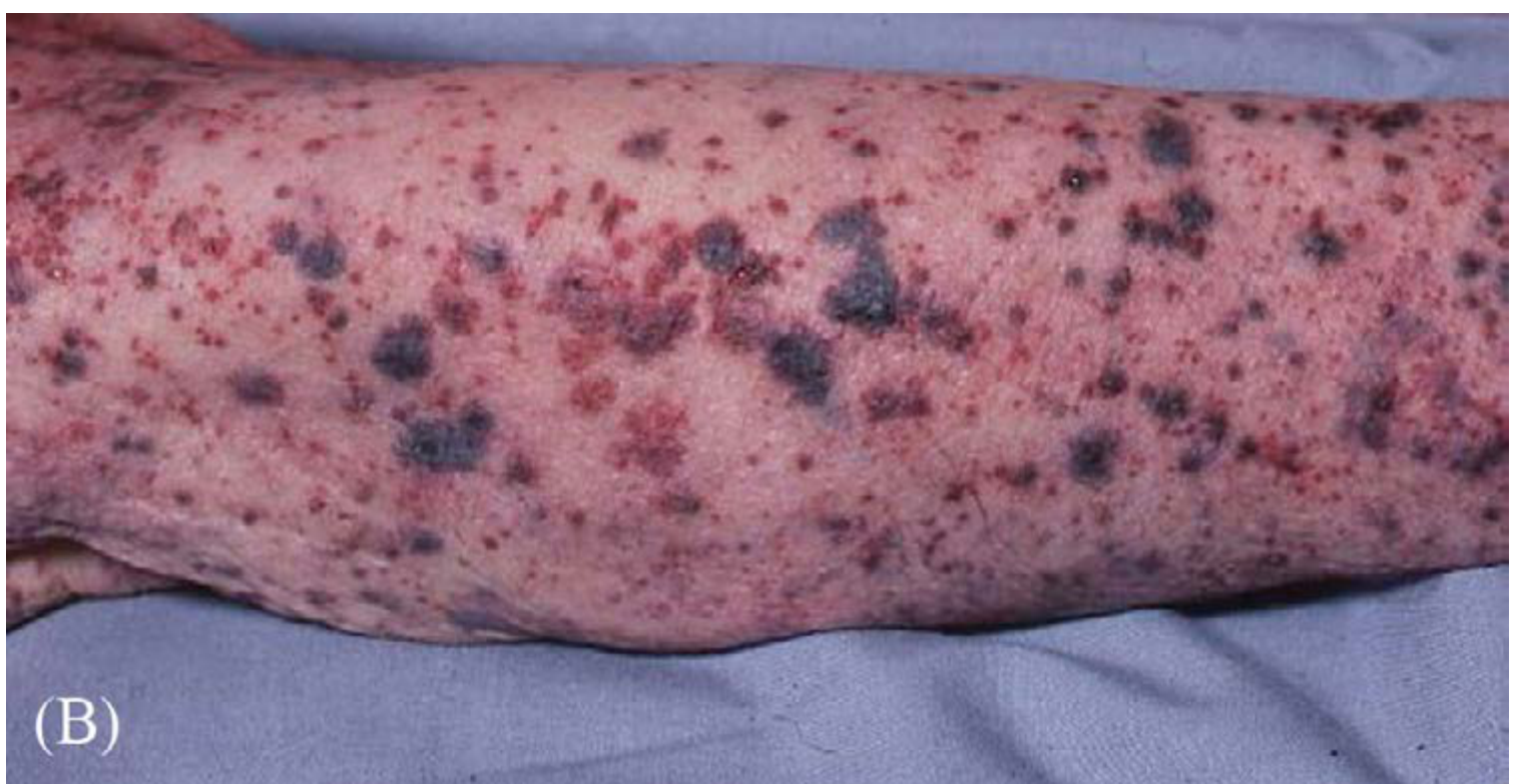 Petechiae and purpura in arm hanging over a bed terminally