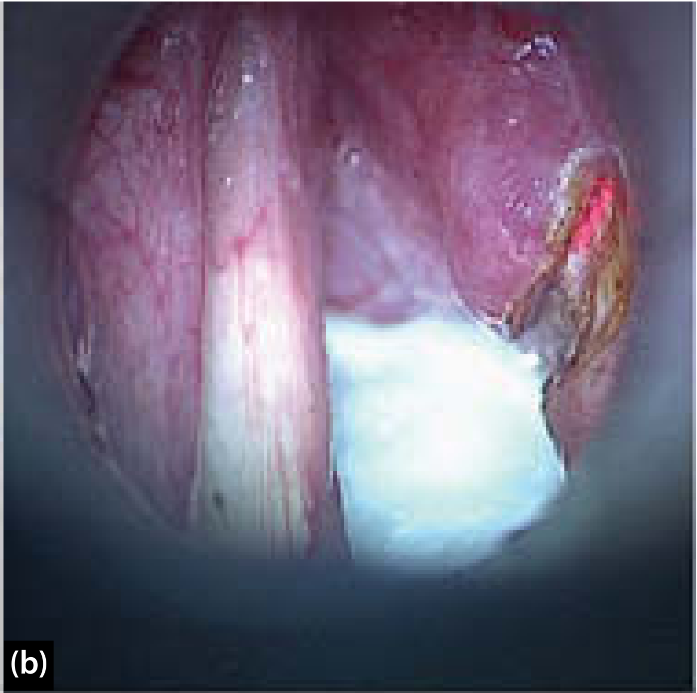 Endoscopic view of laryngeal tumor