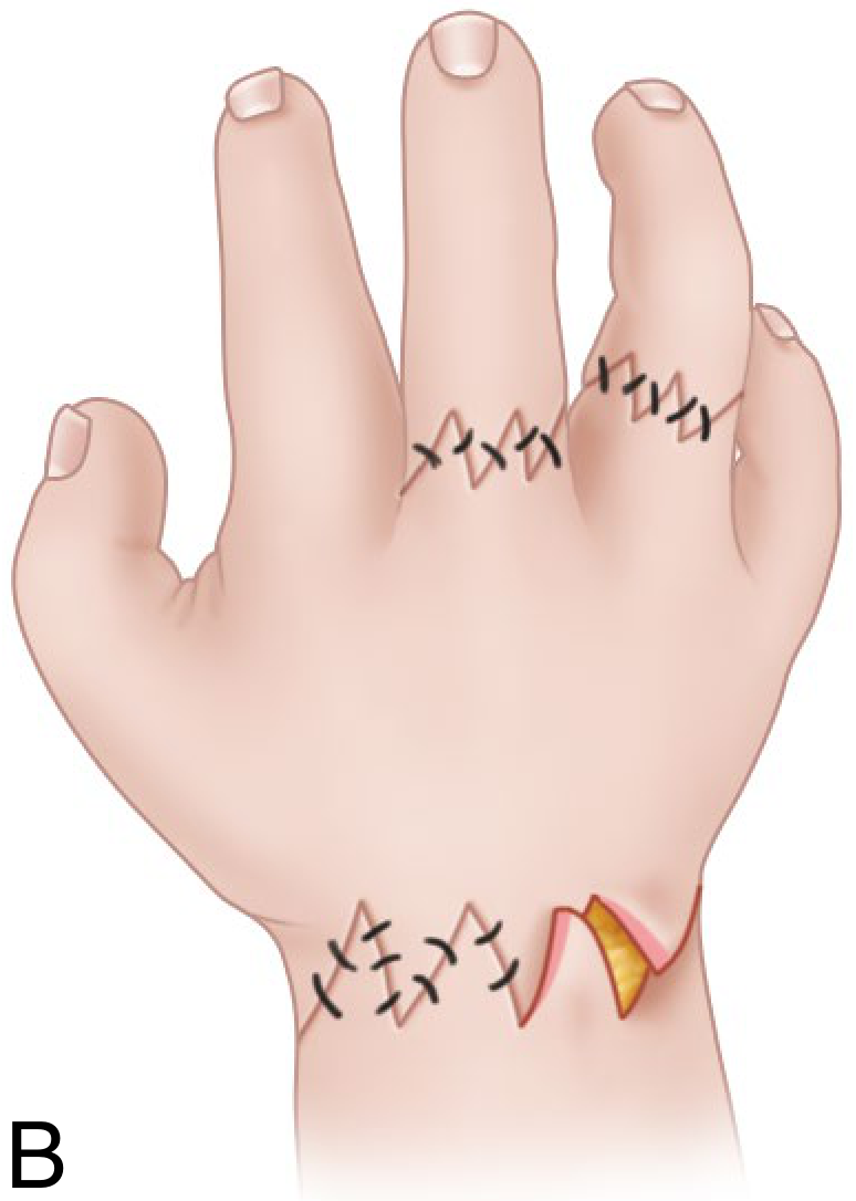 Z-plasty closure after constriction band excision