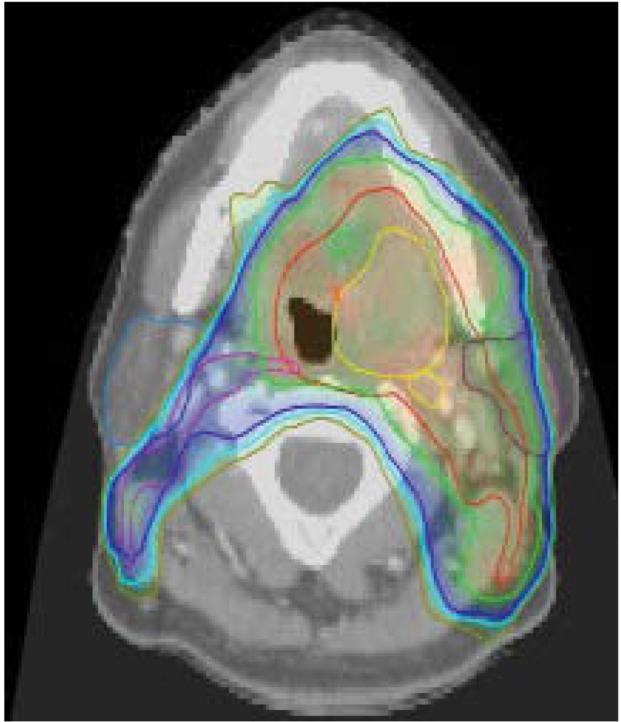IMRT Plan for Left Tonsillar Carcinoma showing GTV (yellow), CTV1 radical dose (red), CTV2 prophylactic (purple) with 62.7 Gy, 51.3 Gy and 48 Gy isodose lines in green, blue and mustard respectively
