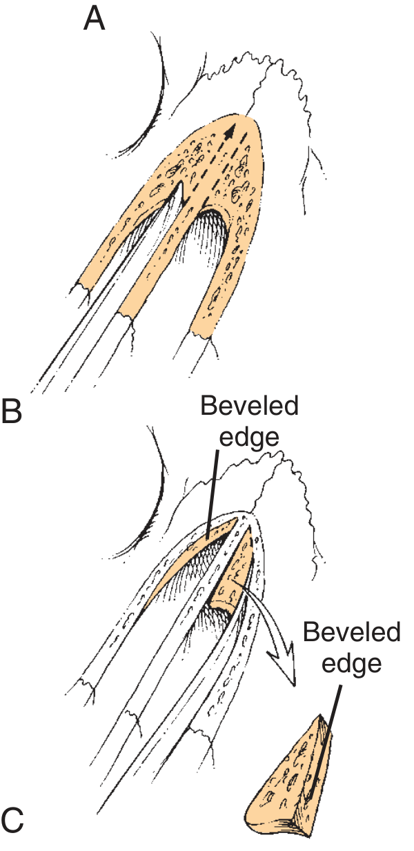 Osteotome beveled edge in nasal osteotomy - planes of cut for rhinoplasty